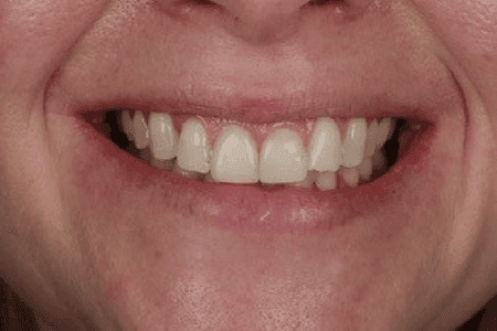 Restorative dental teeth