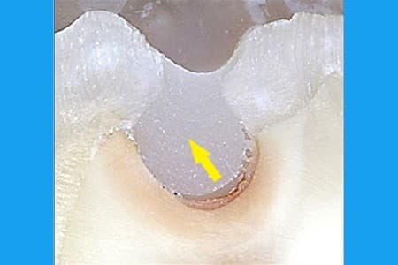 Class 1 composite restoration